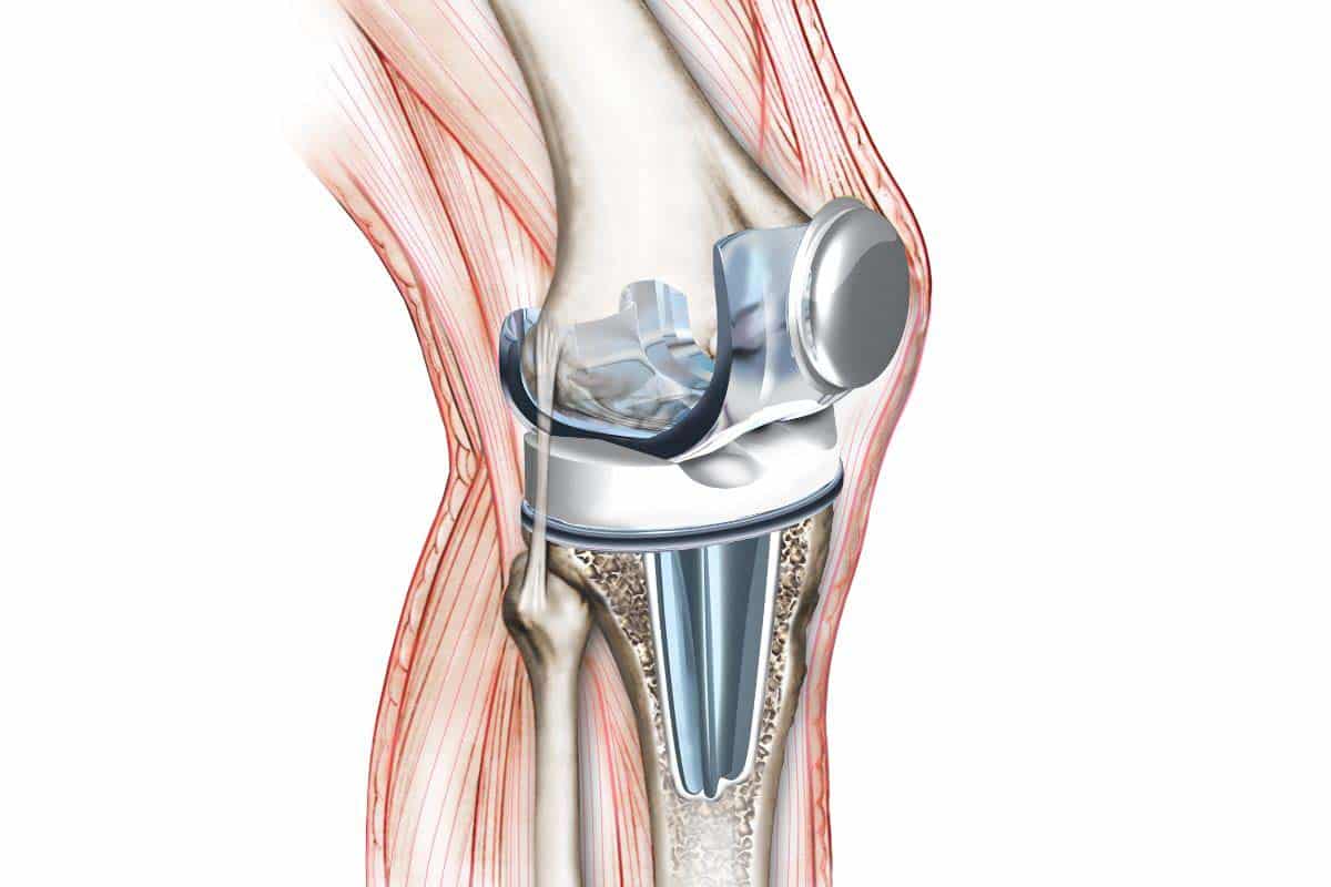 Künstliches Kniegelenk Knieprothese Physiotherapie Basel